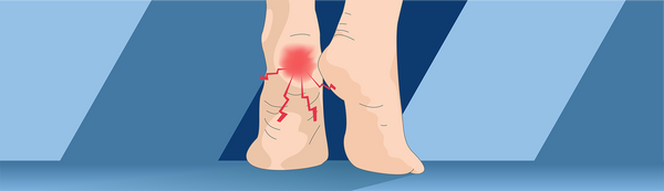 I Think I Have A Heel Spur. What Should I Do?