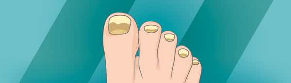 Why Is My Toenail Growing Thick & Discoloured?