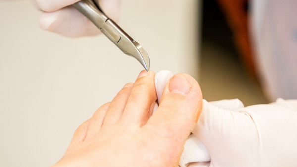 Why antibiotics won't fix your ingrown toenail